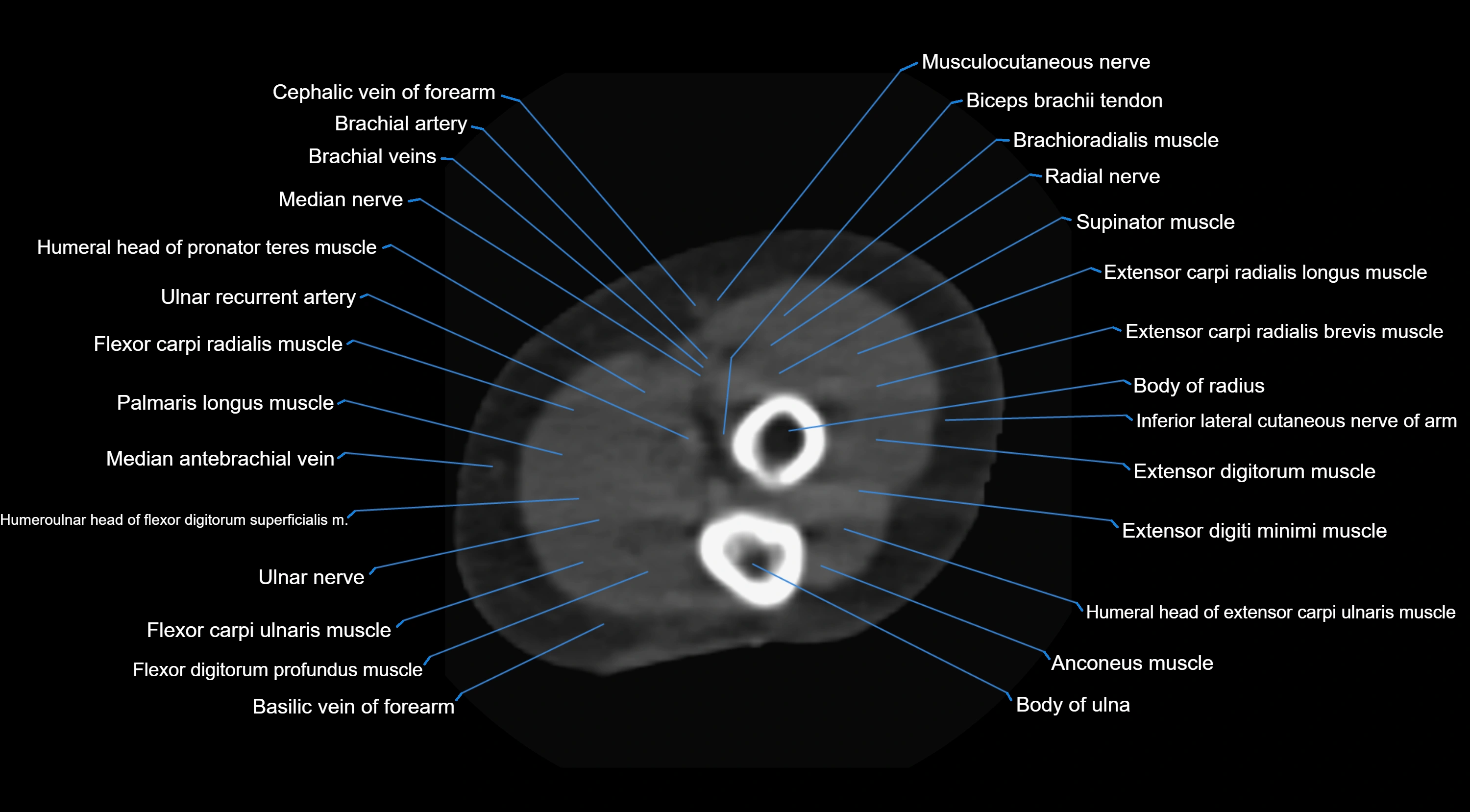 CT elbow axial  cross sectional anatomy labelled  radiology image -00043.webp